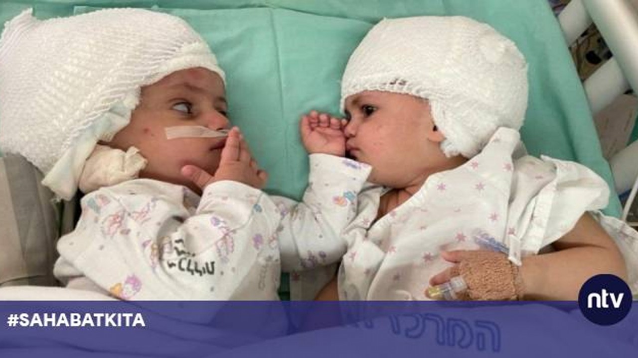 Bayi wanita kembar siam berhasil dipisahkan melalui operasi.