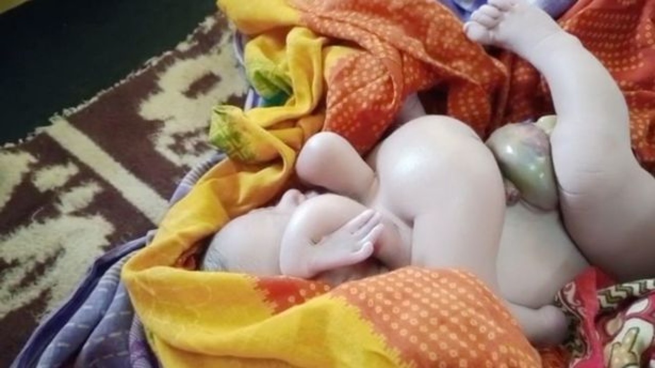 Bayi lahir dengan 4 tangan dan 4 kaki. (Daily Star)