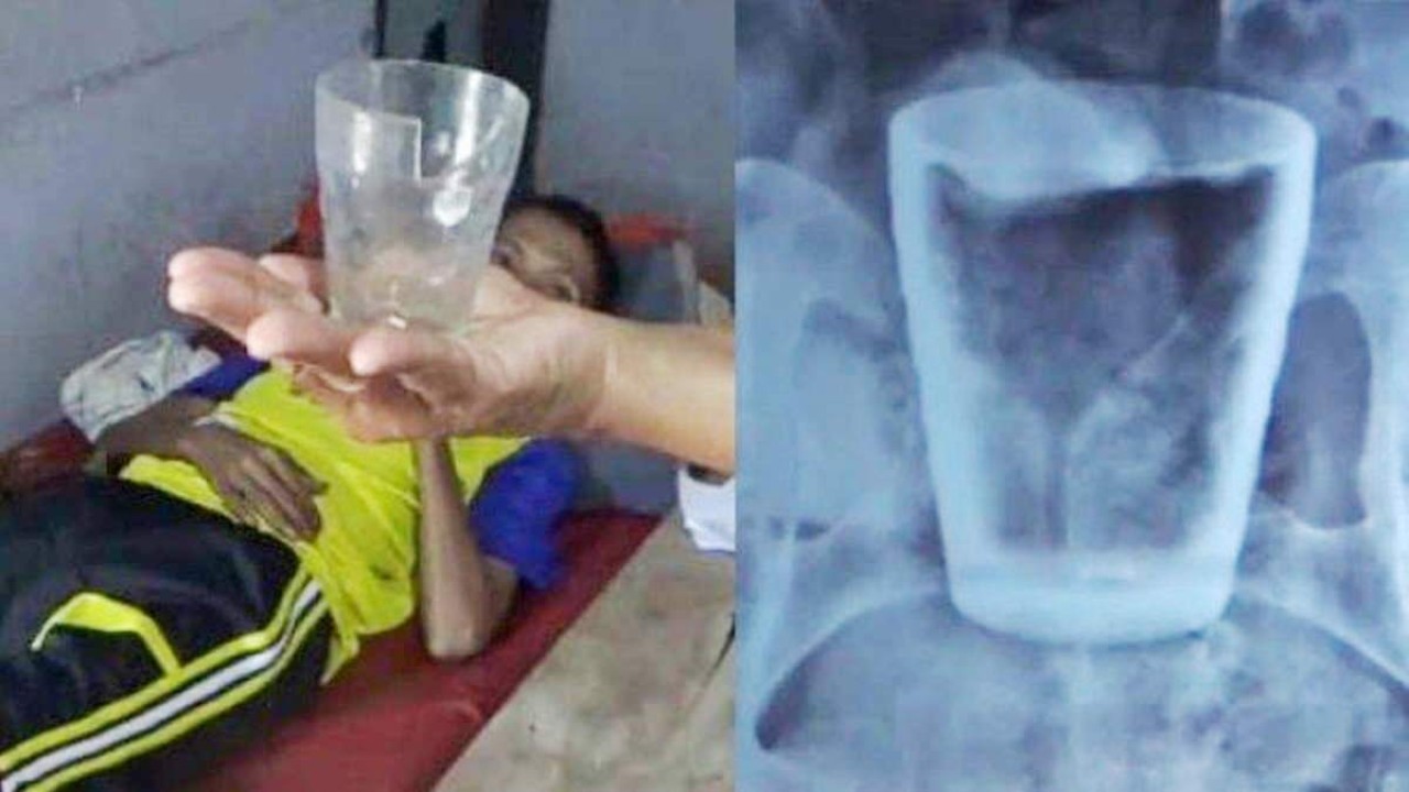Tim medis RSD Balung Jember berhasil mengeluarkan gelas kaca dari perut Lasiadi/ist