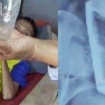 Tim medis RSD Balung Jember berhasil mengeluarkan gelas kaca dari perut Lasiadi-1649251486