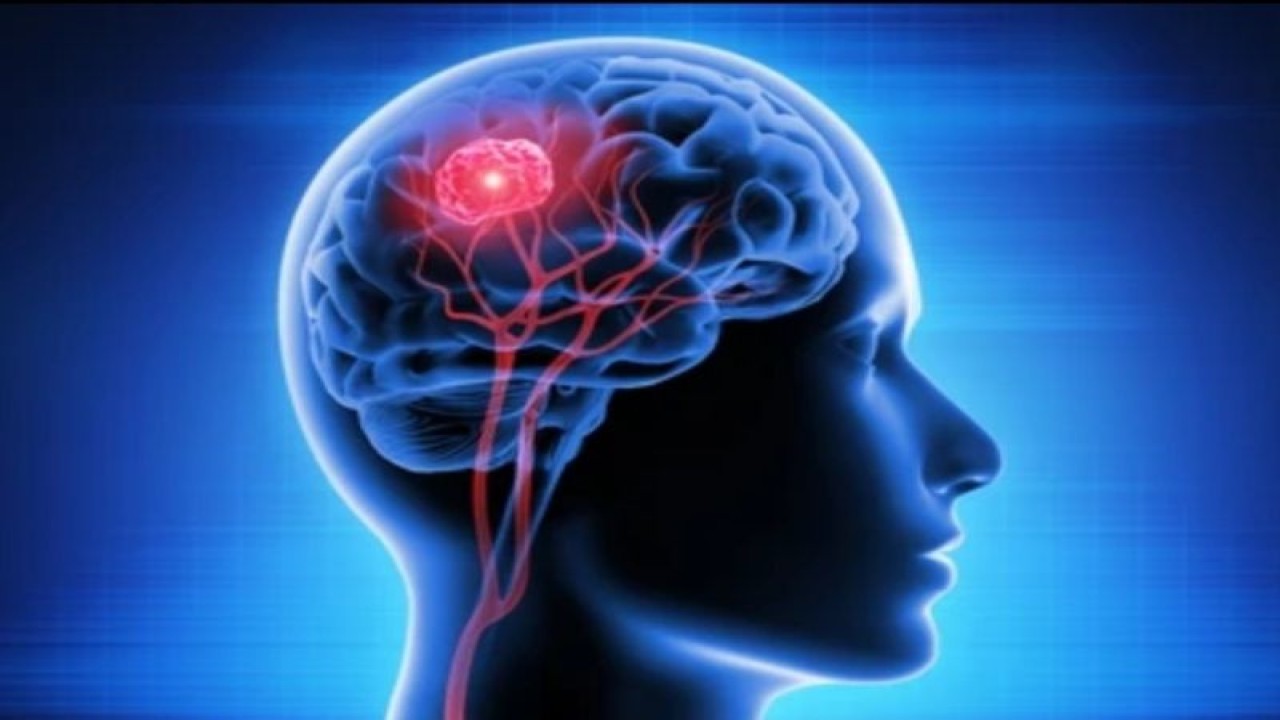 Ilustrasi tumor otak (ANTARA/Shutterstock)