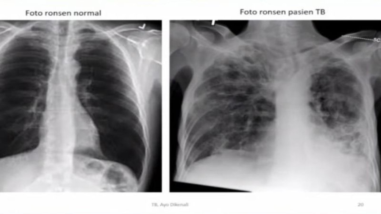 Ilustrasi - Foto scan perbedaan kondisi paru-paru pasien normal dan penderita Tuberkulosis (TBC). (ANTARA/HO-Kemenkes).