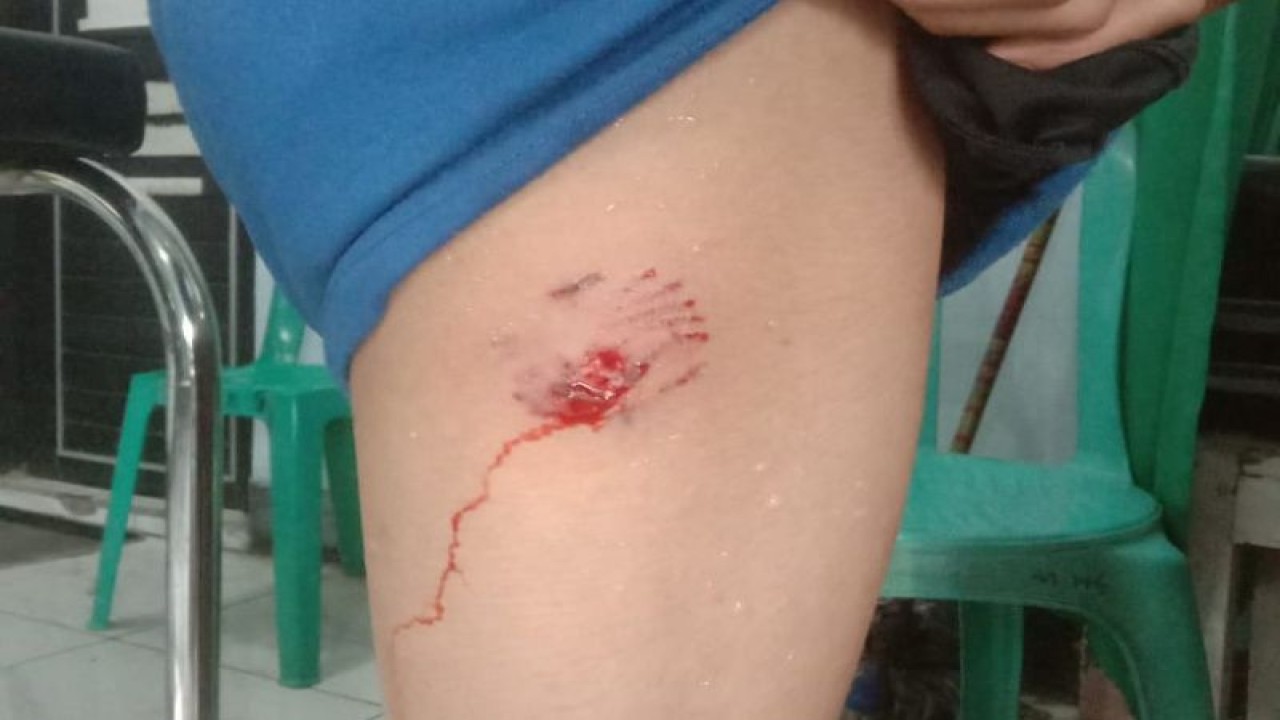 Luka korban akibat gigitan anjing rabies di Dompu, NTB (ANTARA/Humas Polres Dompu)