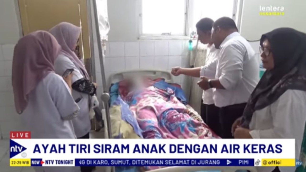 RNF korban penyiraman air keras oleh ayah tirinya harus mendapat perawatan intensif di rumah sakit